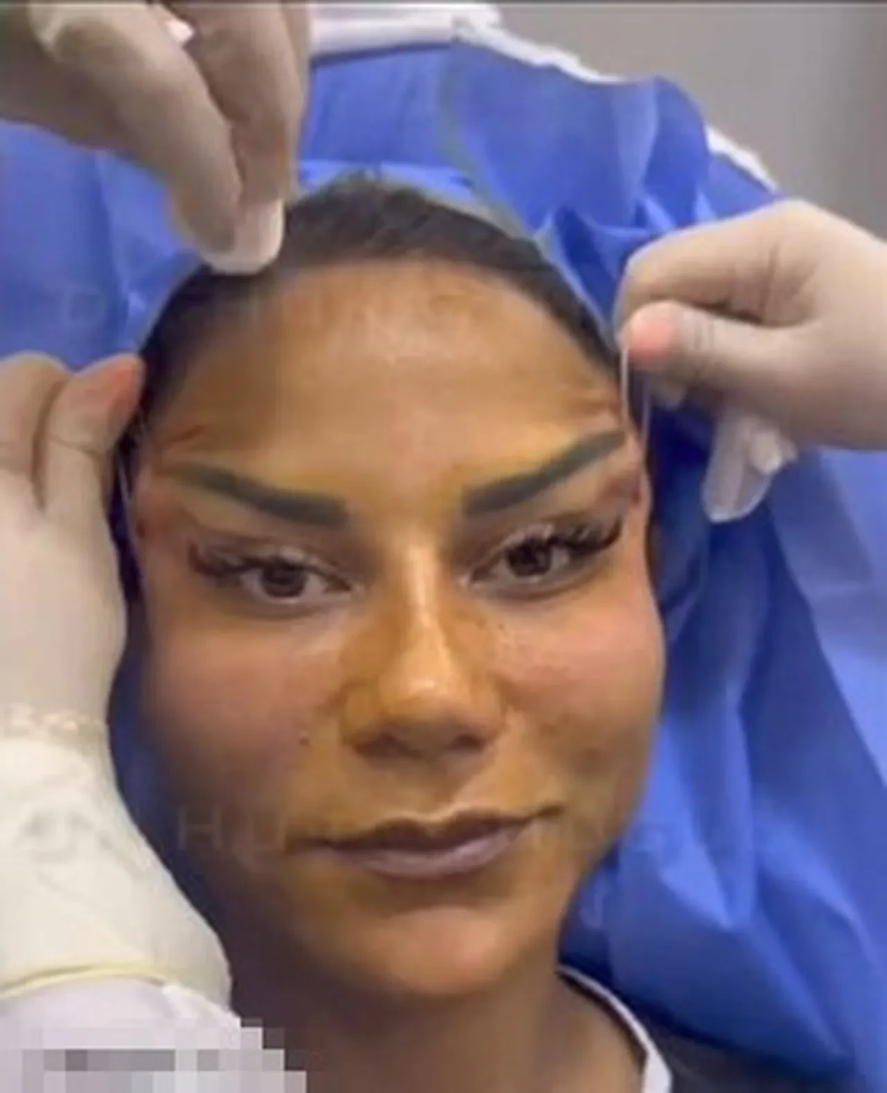 Estetiğe 200 bin TL harcadı, hayatı kabusa döndü