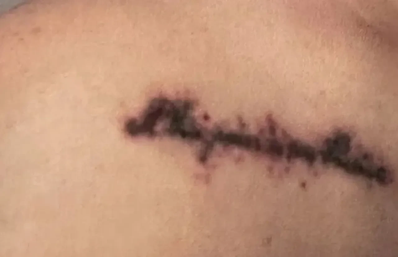 Ünlü yazar Merve Köken ölümden döndü! Dövme sildirmek için gitti, kabusu yaşadı