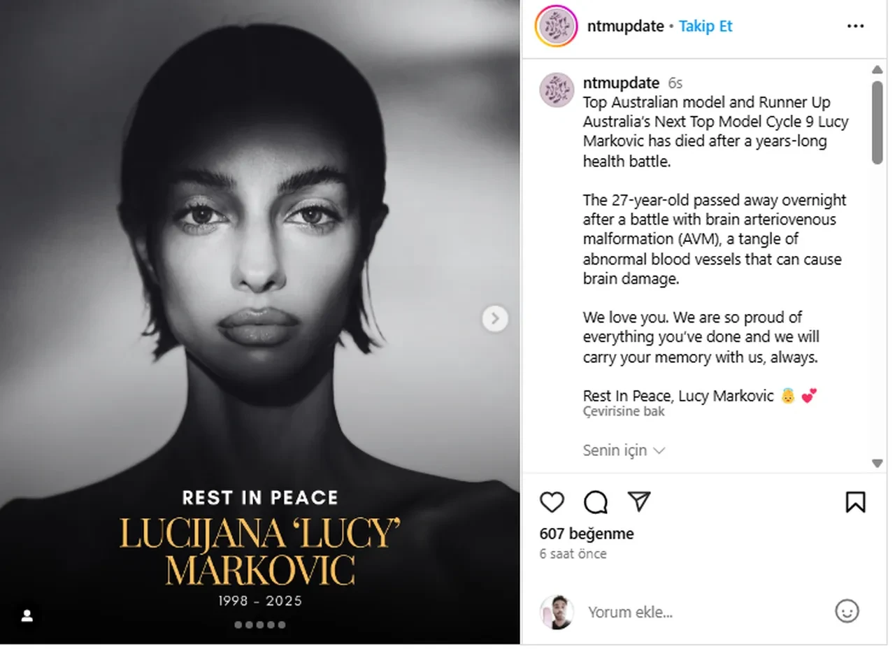 Dünyaca ünlü manken 27 yaşında hayatını kaybetti! Ölüm sebebi AVM hastalığı