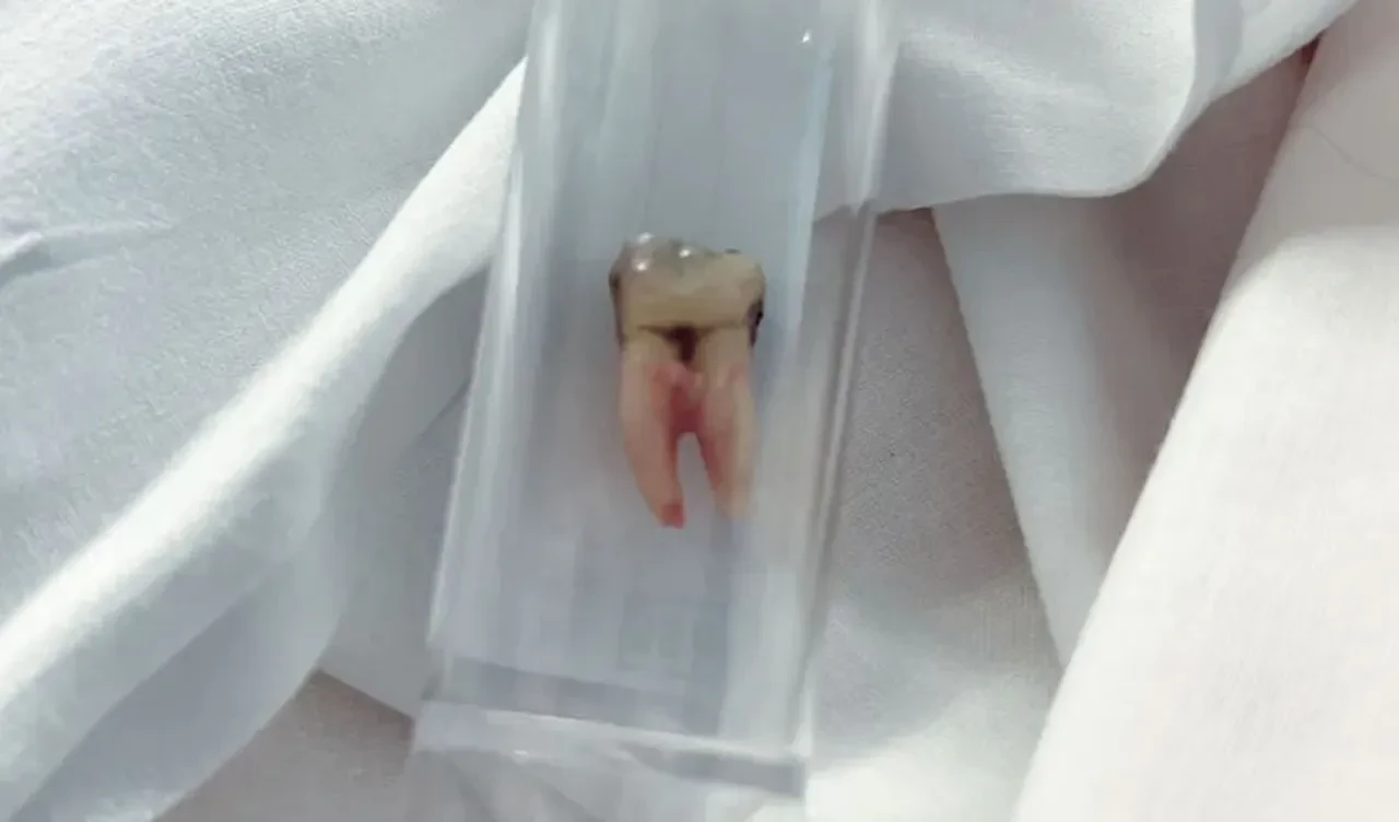 'Basit bir diş ağrısı' ölüme çok yaklaştırdı! Artık herkesi uyarıyor