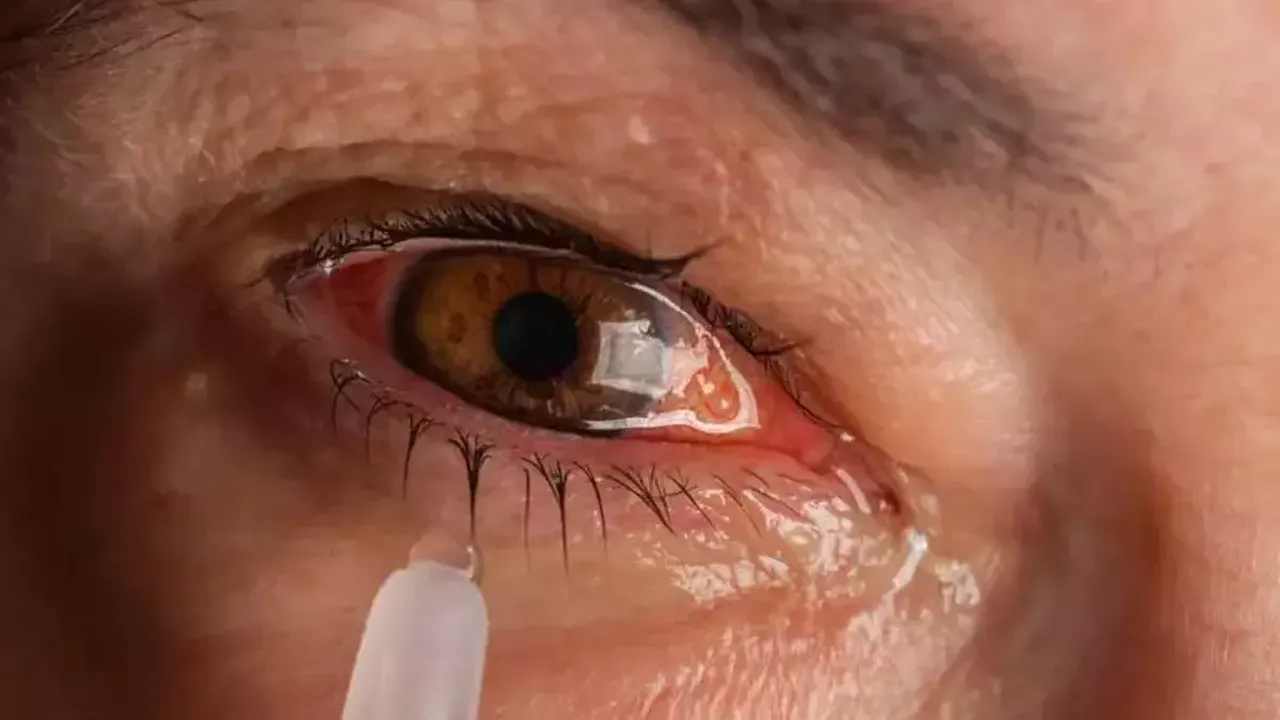 Göz kapaklarınızda sürekli kızarıklık varsa sorun bu olabilir