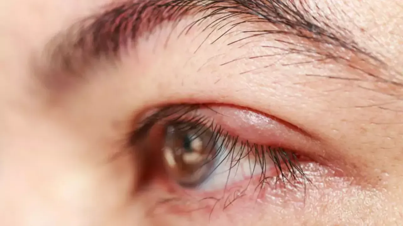Göz kapaklarınızda sürekli kızarıklık varsa sorun bu olabilir