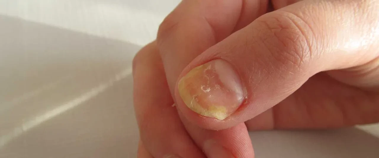 Tırnaklar kanser riskinin habercisi olabilir mi?