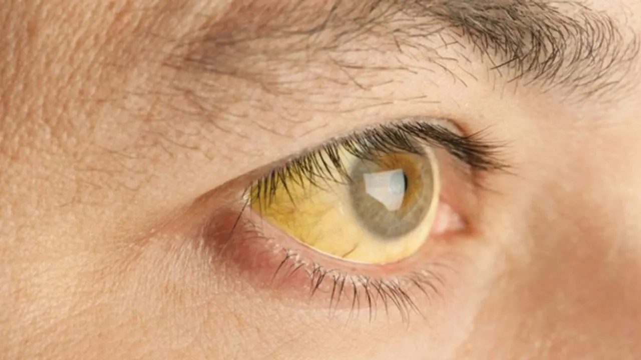 Sarıhumma nedir nasıl bulaşır? Bir ülkede acil durum ilan edildi