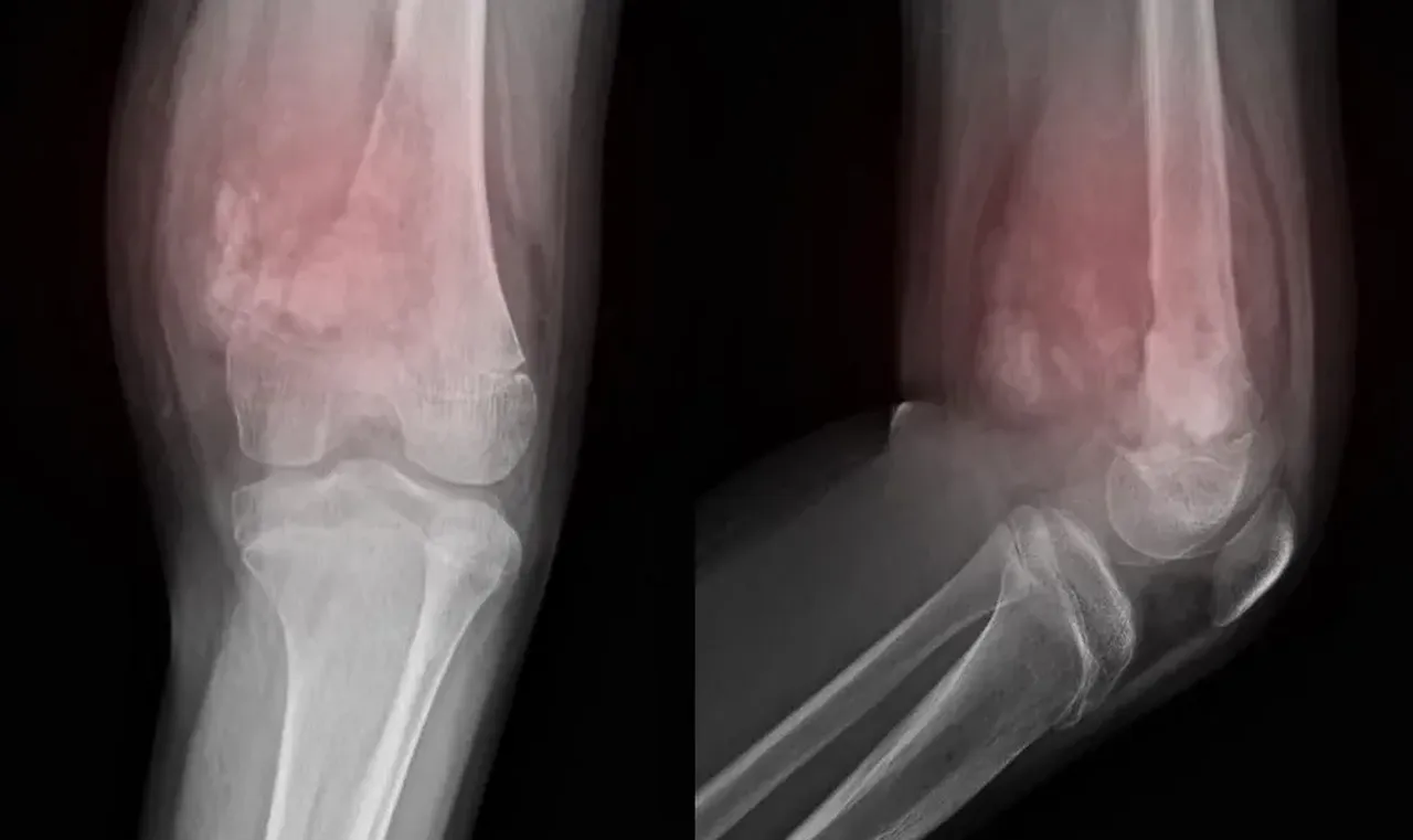 Rabdomyosarkom Nedir? Çocuklarda görülen kabus gibi hastalık