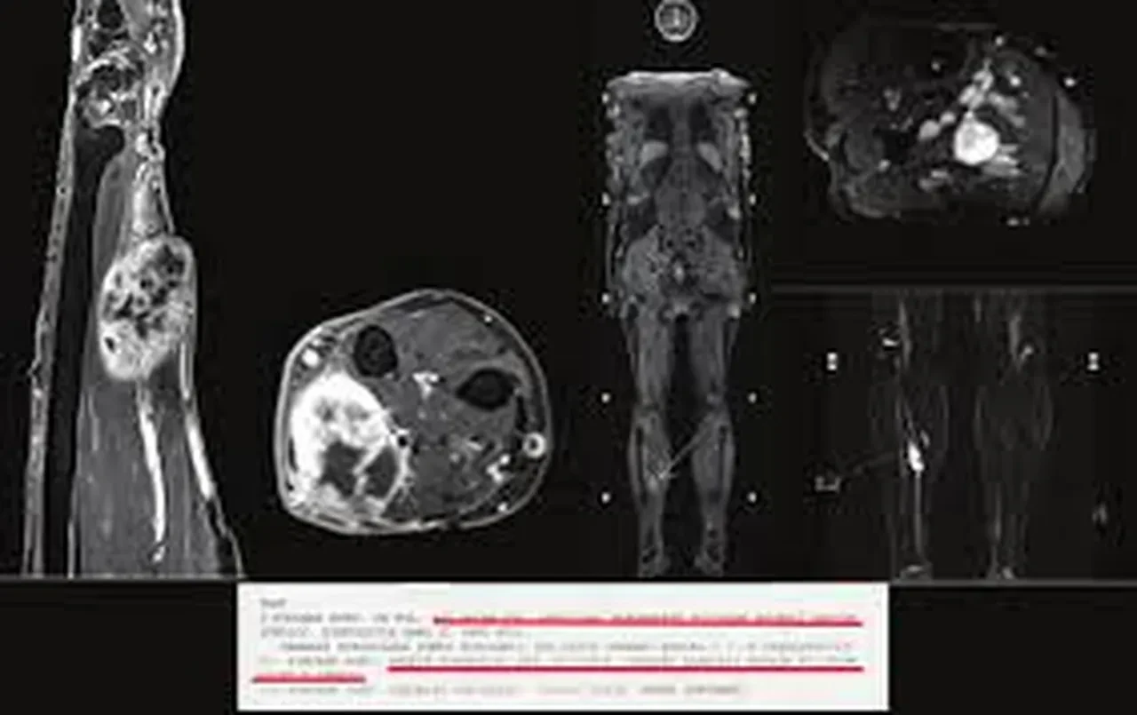 Rabdomyosarkom Nedir? Çocuklarda görülen kabus gibi hastalık