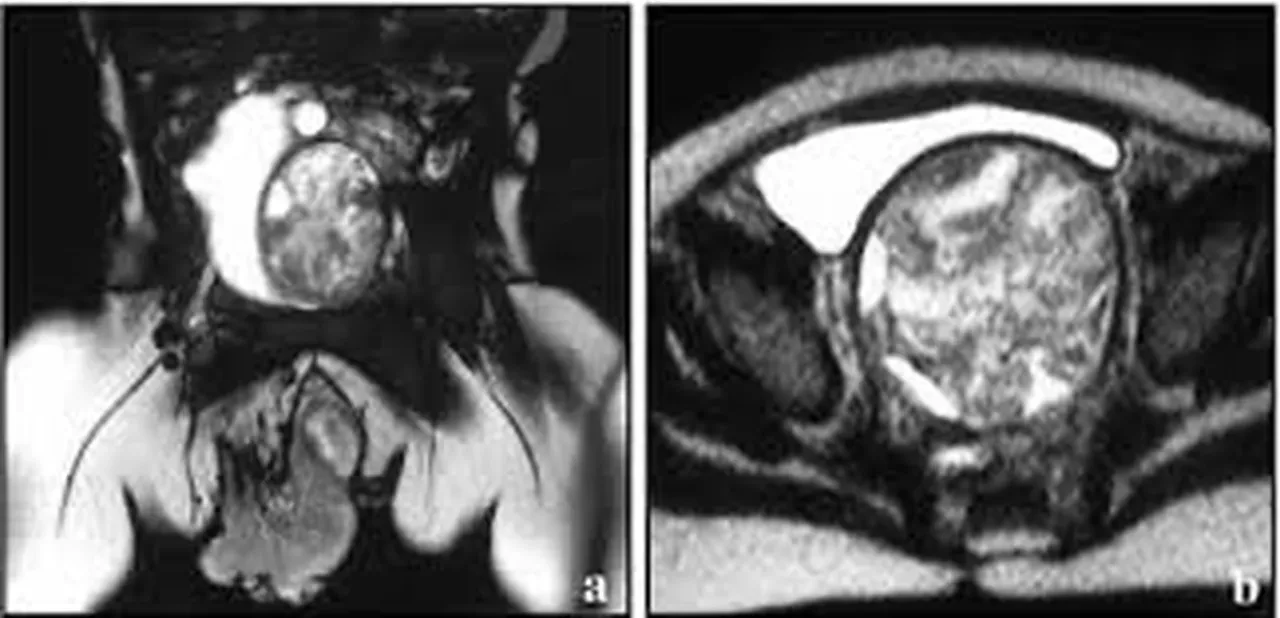 Rabdomyosarkom Nedir? Çocuklarda görülen kabus gibi hastalık
