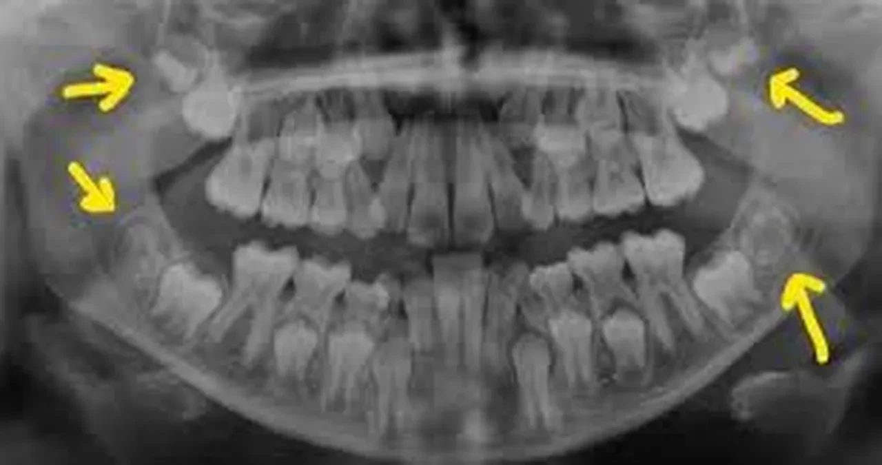 Yirmi yaş dişleri artık altın kadar değerli! Özel bankalarda saklanıyor