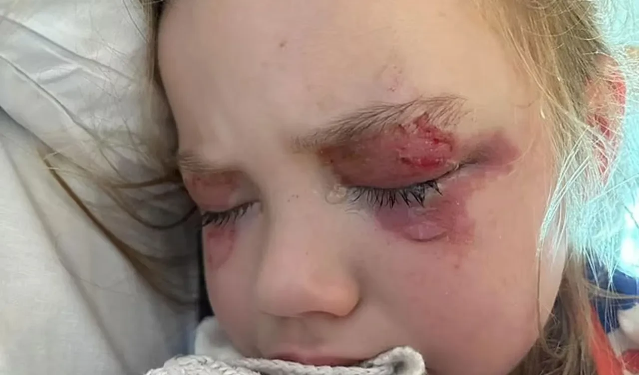 Çocuk şeker zannedip ısırdı, bir gözü kör oldu! Anne şimdi herkesi uyarıyor