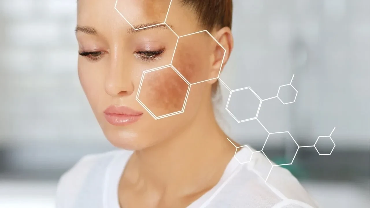 Cilt lekelerine anında çözüm! 4 malzemeyle 1 haftada pürüzsüz yüz