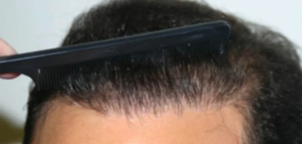 Saç ektirme ve boyatma İslam'da caiz mi?