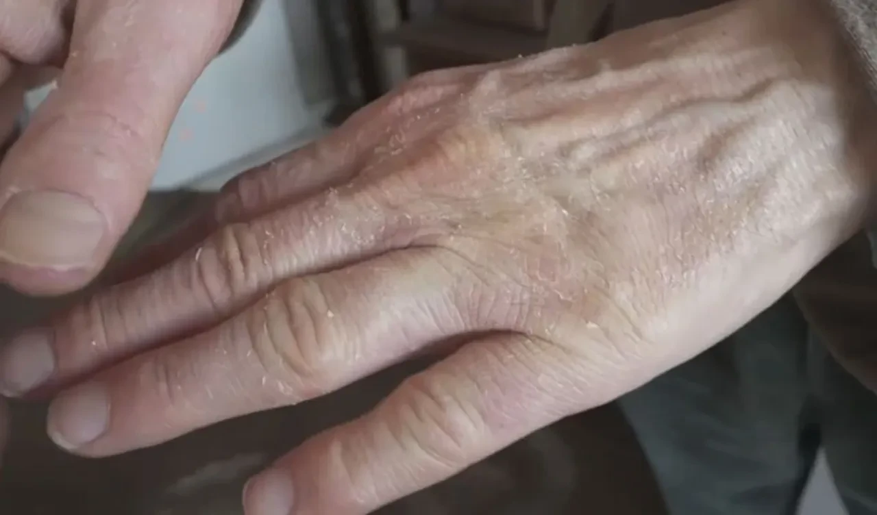 Kabak pişirip yedi başına gelmeyen kalmadı! Zehirli olduğunu öğrenince şoke oldu