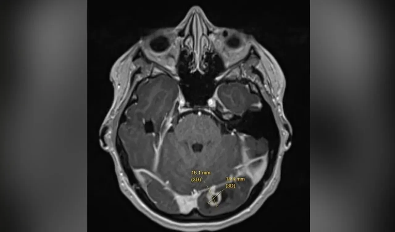 Migren zannetti ölümcül hastalık çıktı! Şimdi herkesi bu belirtiler konusunda uyarıyor