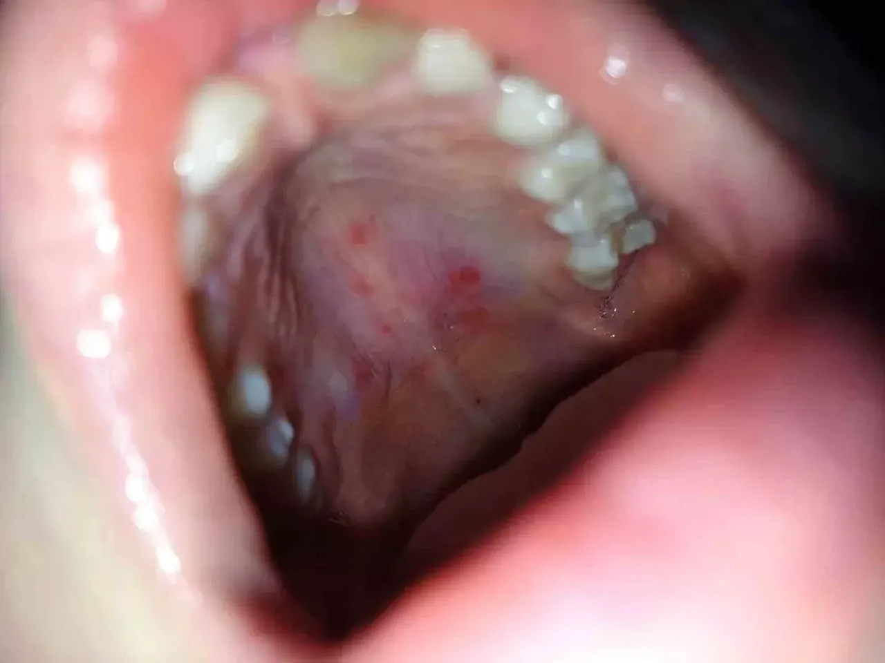 Ateş ve ağız içi yaralar ile başlıyor! Çocukları tehdit eden yeni virüs yayılmaya başladı