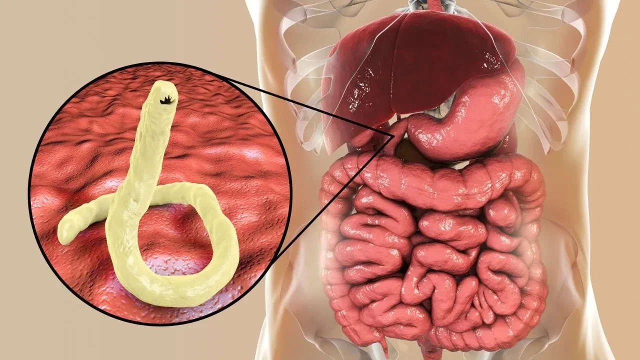 1 milyondan fazla kişi iç parazitle yaşıyor! Bu belirtiler varsa acilen doktora görünün