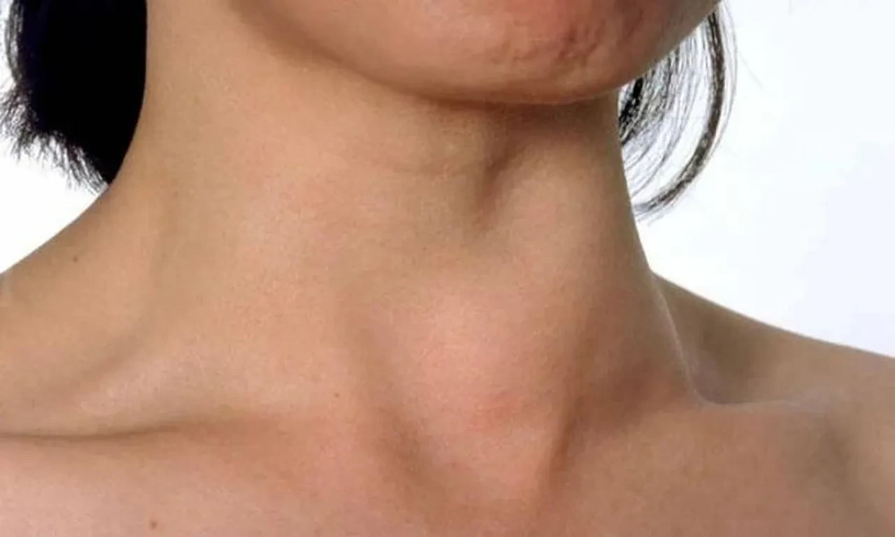 Guatr hastalığı nedir? Hemen herkeste var ama kimse bir şey bilmiyor