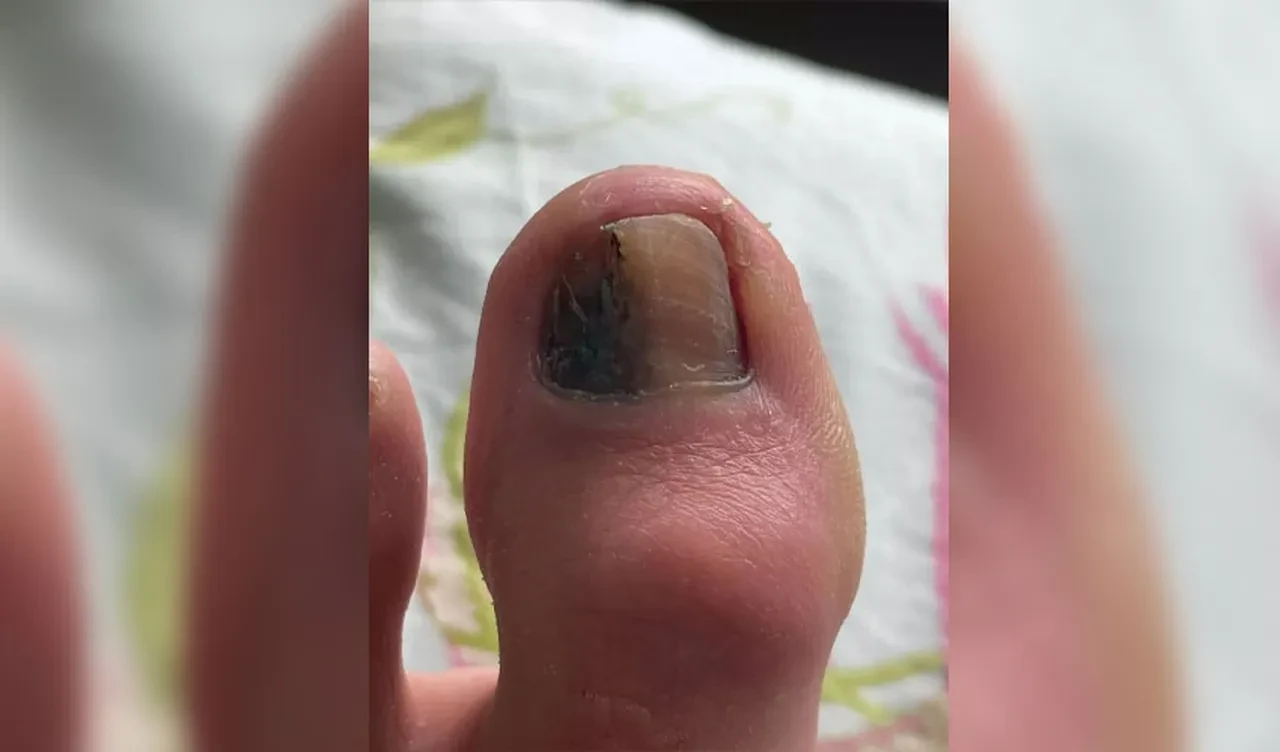 Ayak tırnağındaki lekeye aldırış etmedi! Kısa süre sonra hayatı alt üst oldu