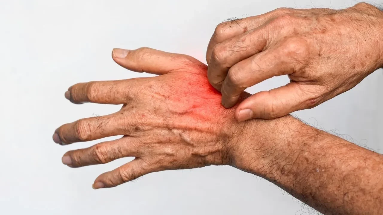 Egzama sorununun altında bağırsak problemi yatıyor olabilir! Bu beslenme yöntemi etkileri azaltıyor