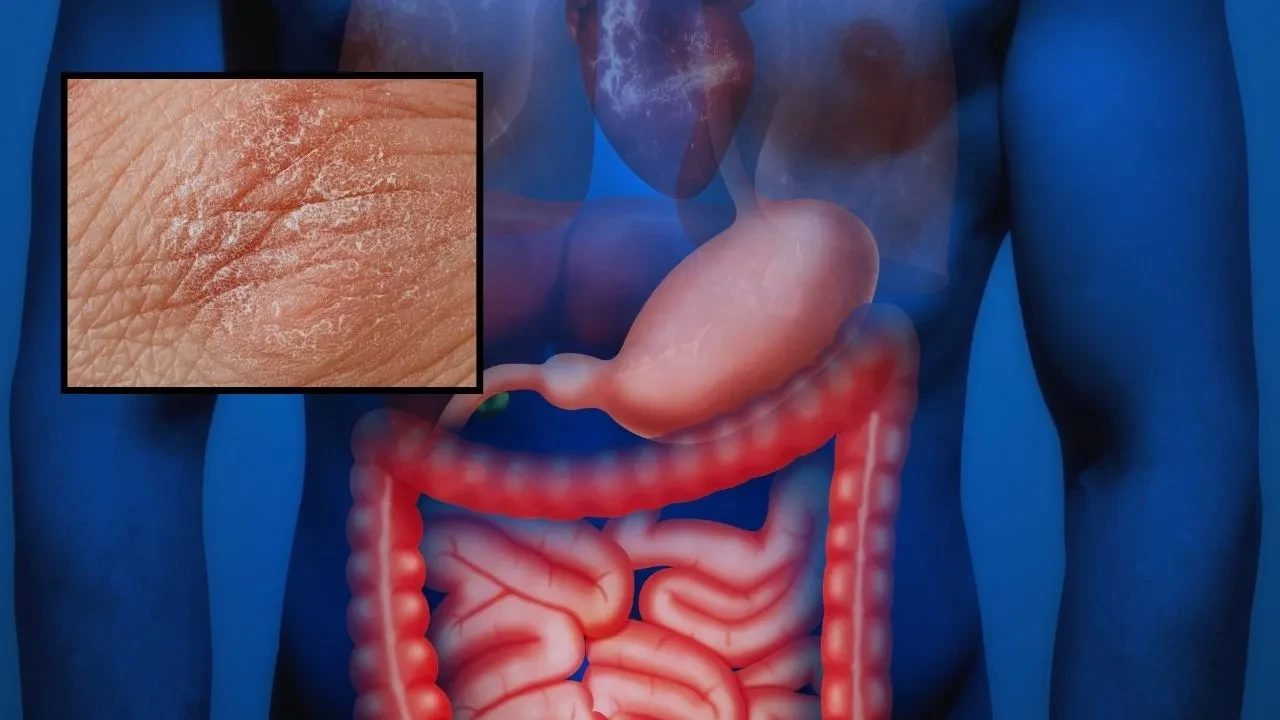 Egzama sorununun altında bağırsak problemi yatıyor olabilir! Bu beslenme yöntemi etkileri azaltıyor