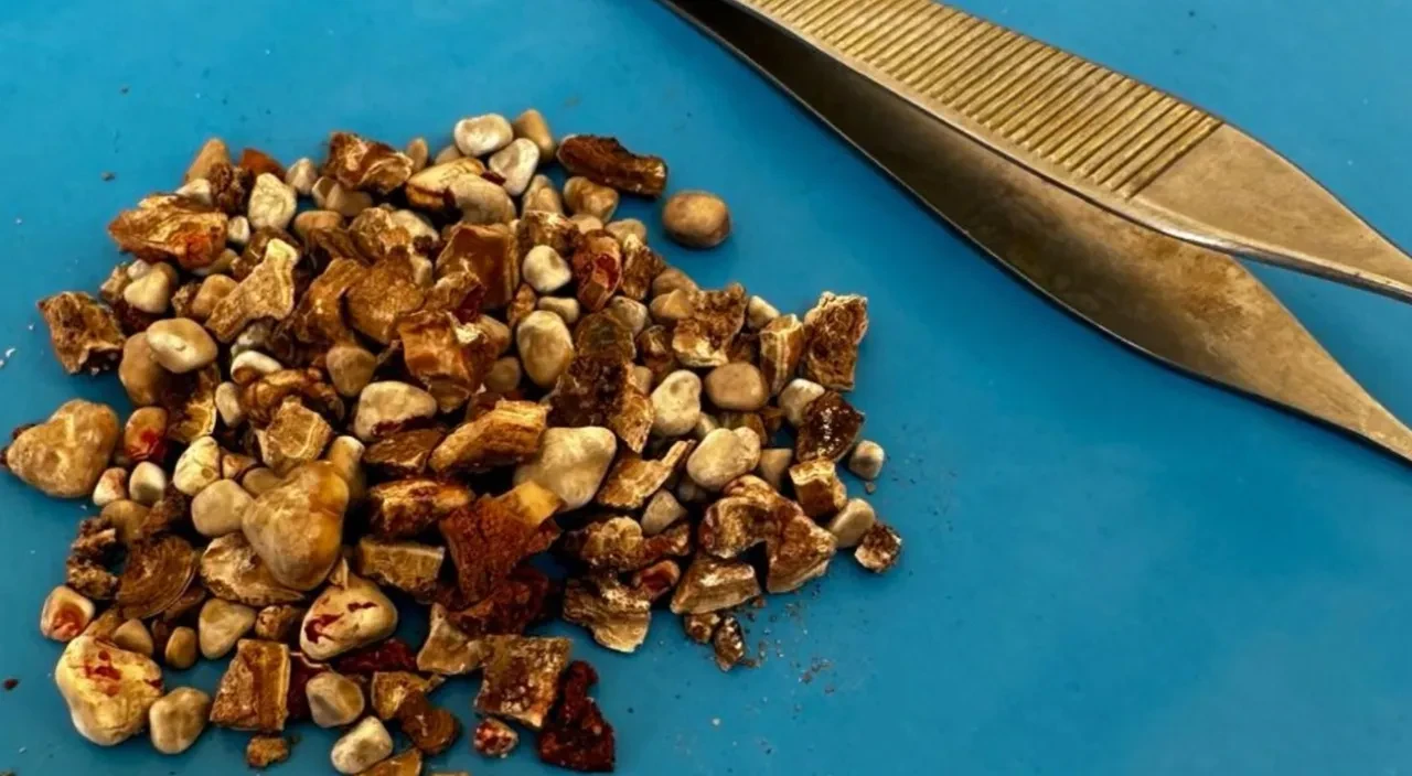 Ameliyatta doktorları şaşkına çevirdi! Say say bitmedi