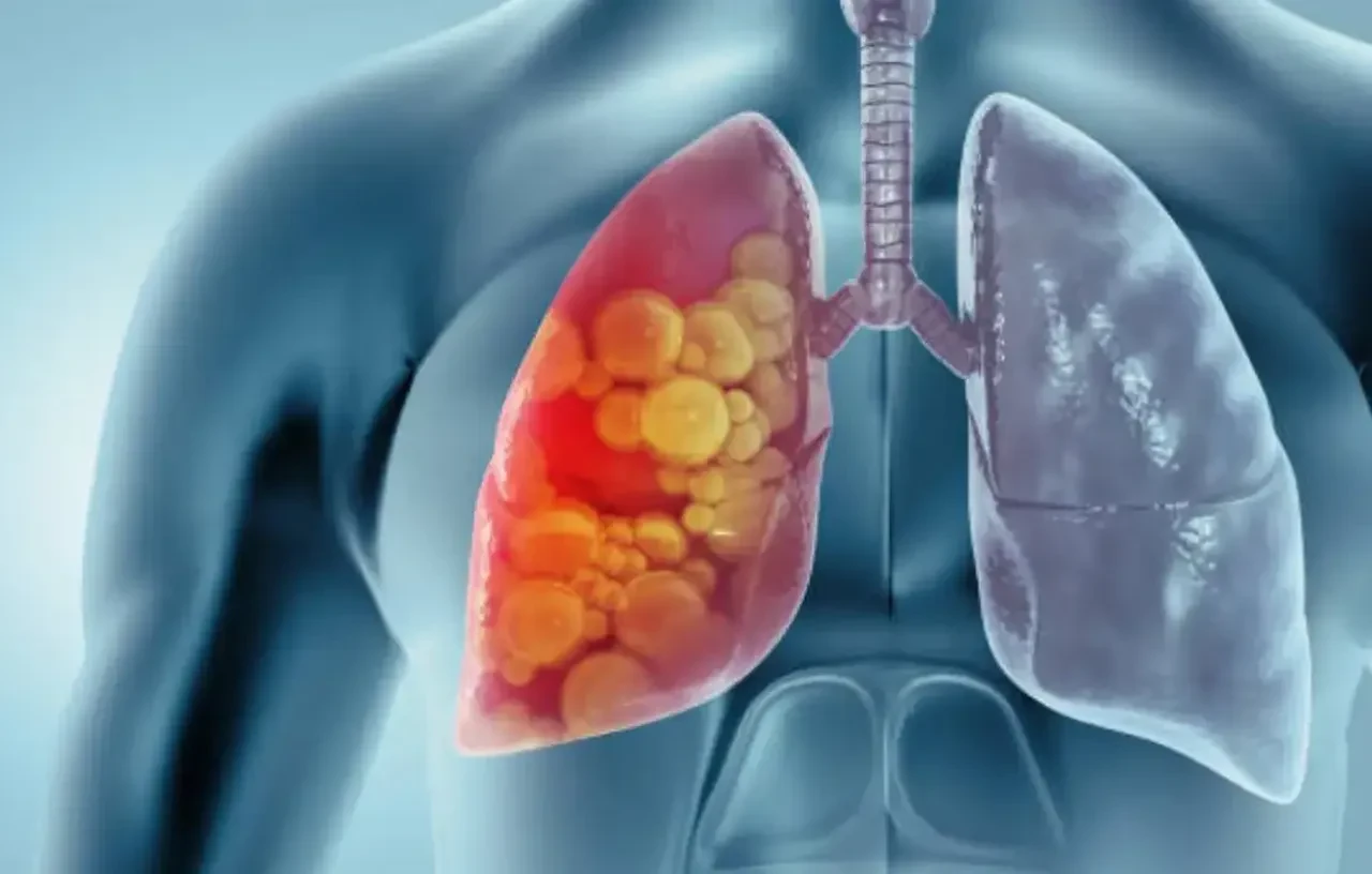 Elektronik sigara hakkında korkunç rapor! Patlamış mısır akciğeri tespiti