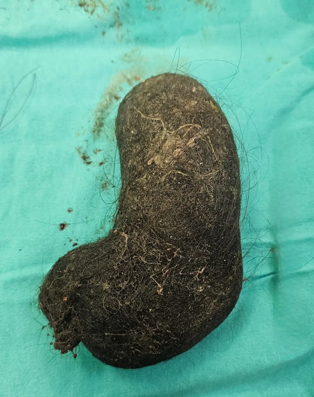 Çocuğun midesinden devasa şekilde çıktı, doktorlar açıklama yaptı: Nadir görülen tablo