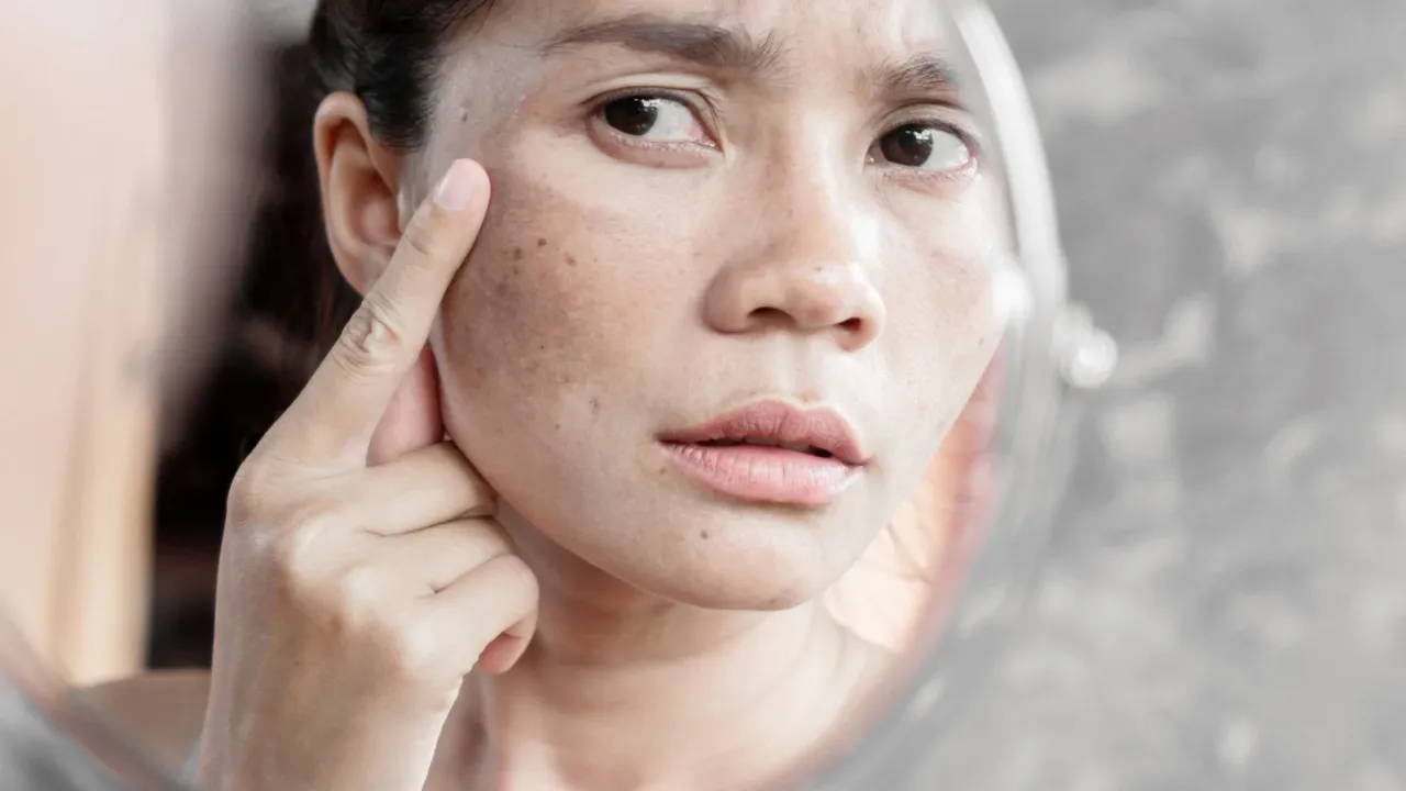 Cilt kanserinin en tehlikelisi burada başlıyor! Belirtileri aynada bile zor görünüyor