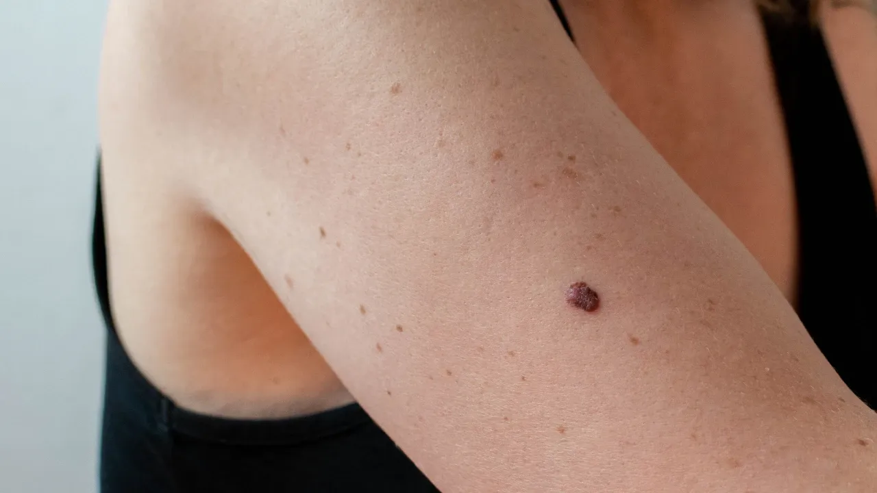 Cilt kanserinin en tehlikelisi burada başlıyor! Belirtileri aynada bile zor görünüyor