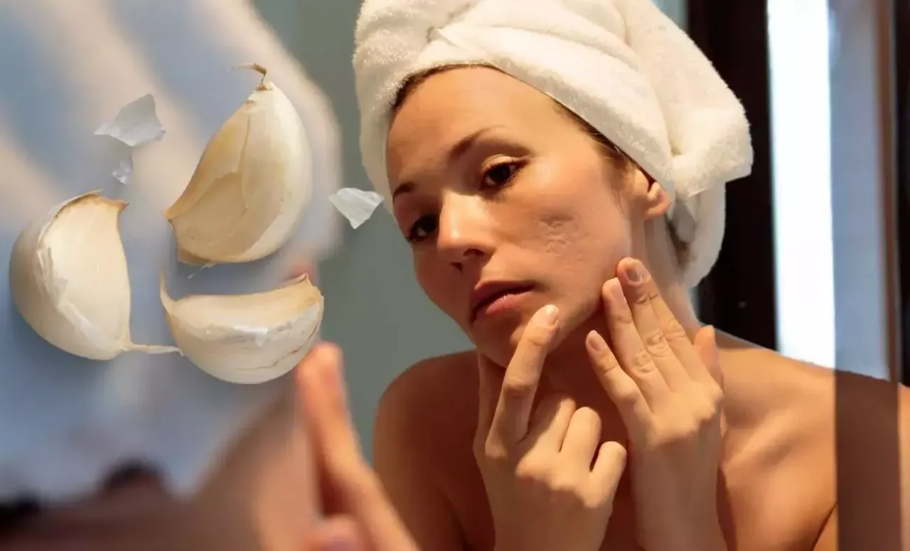 Sarımsak gerçekten sivilceleri geçiriyor mu? Sosyal medyanın konuştuğu formülün perde arkası