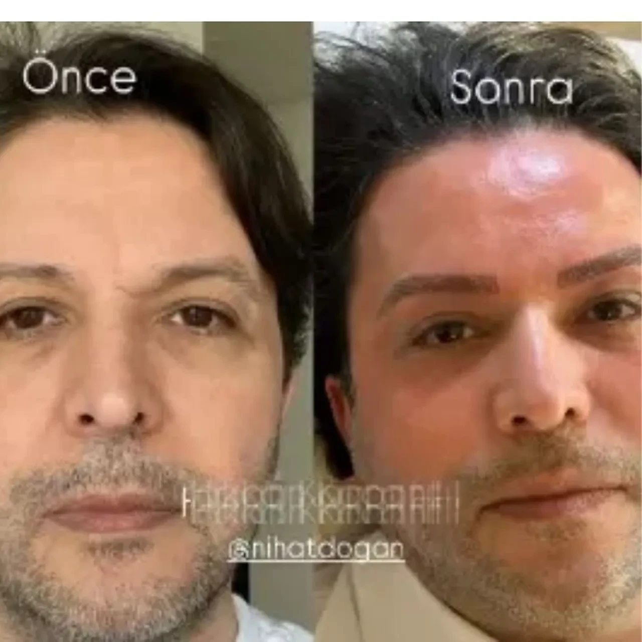 Nihat Doğan estetikle bambaşka birine dönüştü! 