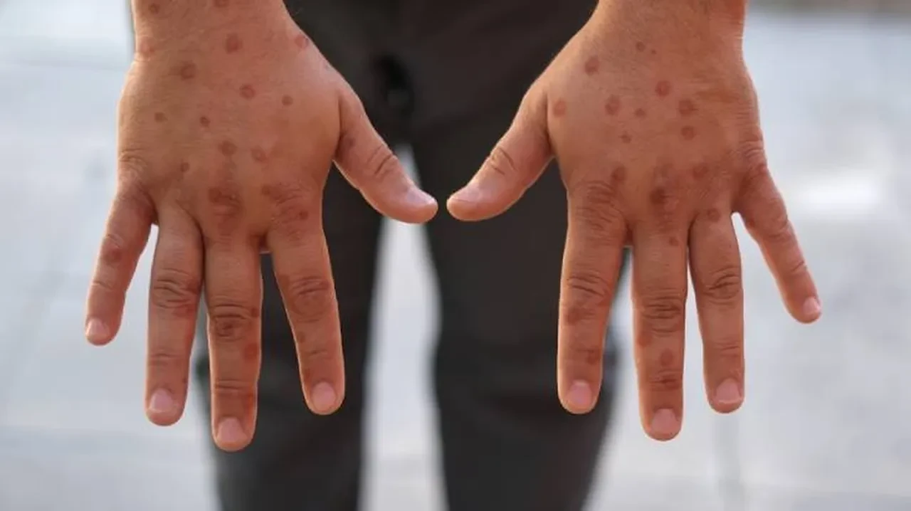 Hem hayvan hem de insanlardan bulaşan virüs için alarm verildi? Vakalar artıyor