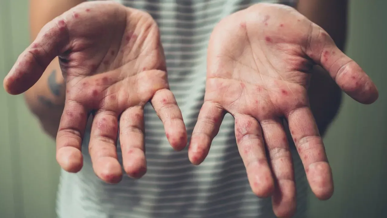 Hem hayvan hem de insanlardan bulaşan virüs için alarm verildi? Vakalar artıyor