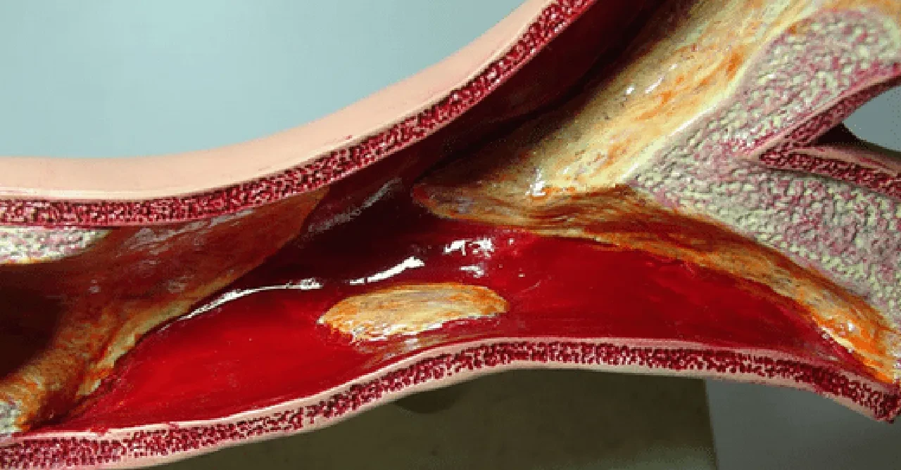 Bu belirtiyi sakın göz ardı etmeyin! Yüksek kolesterolün habercisi olabilir