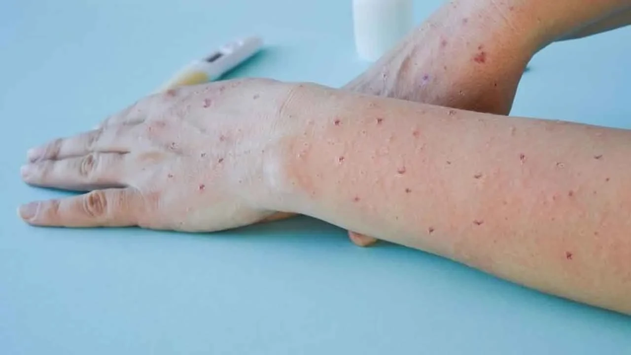 Dünyayı korkutan salgın büyüyor! Bir haftada vakalar yüzde 63 arttı