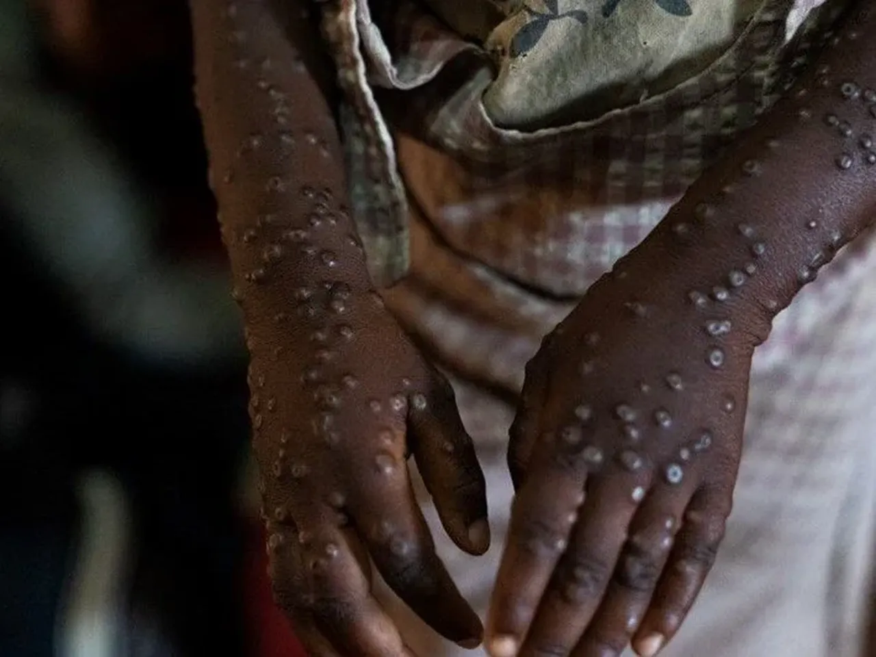 Etiyopya’da M Çiçeği alarmı: İlk ölüm kayıtlara geçti, 5 vaka aktif!