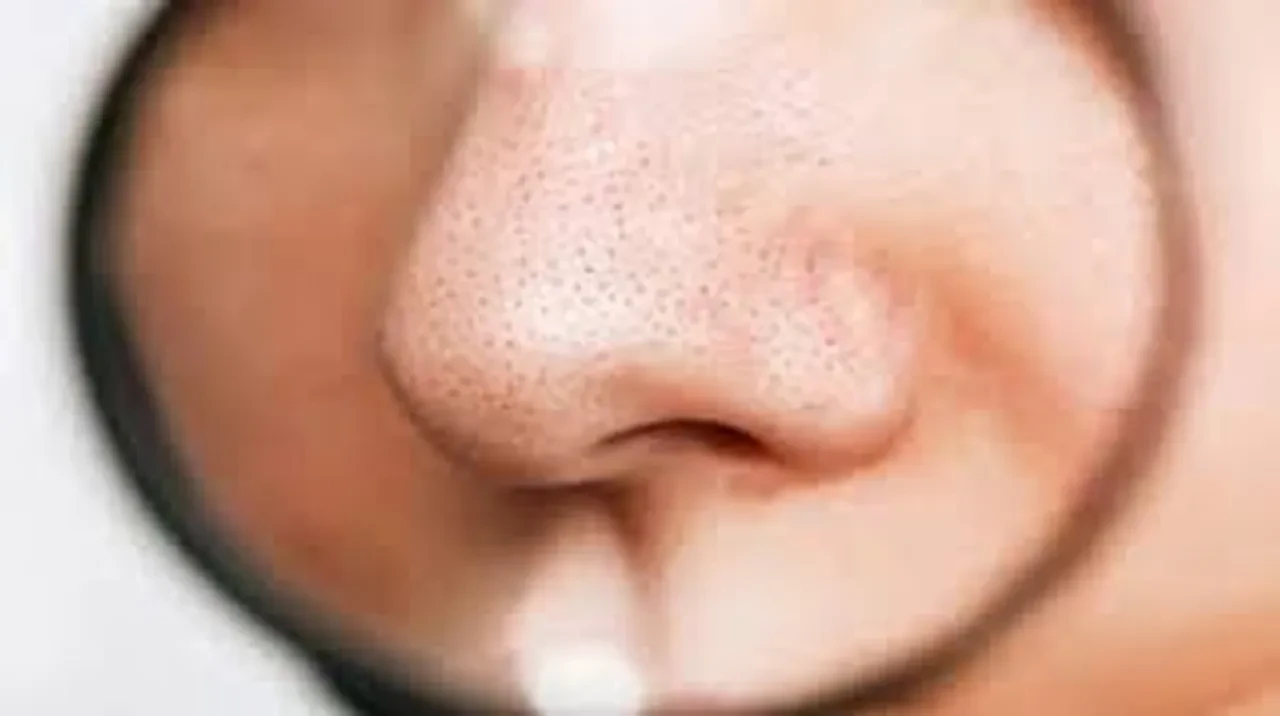 Geçmek bilmeyen sivilce kanserin habercisi olabilir mi?
