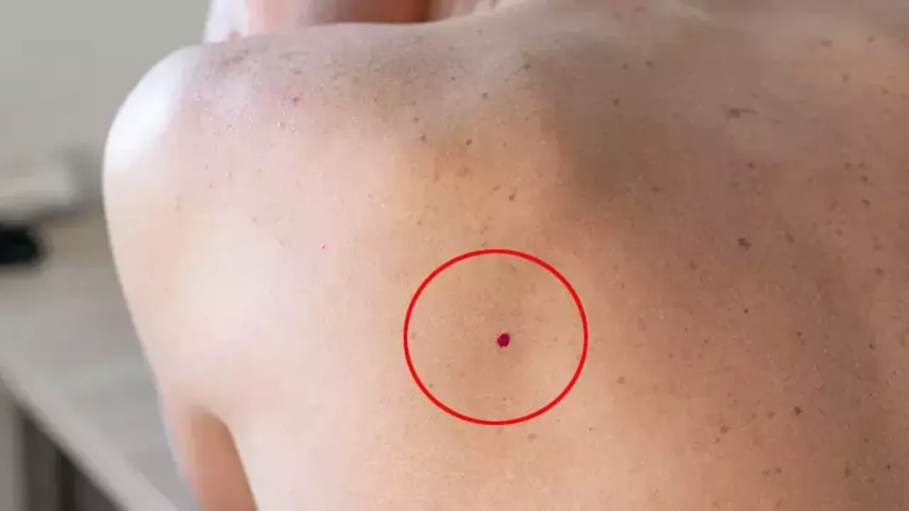 Geçmek bilmeyen sivilce kanserin habercisi olabilir mi?