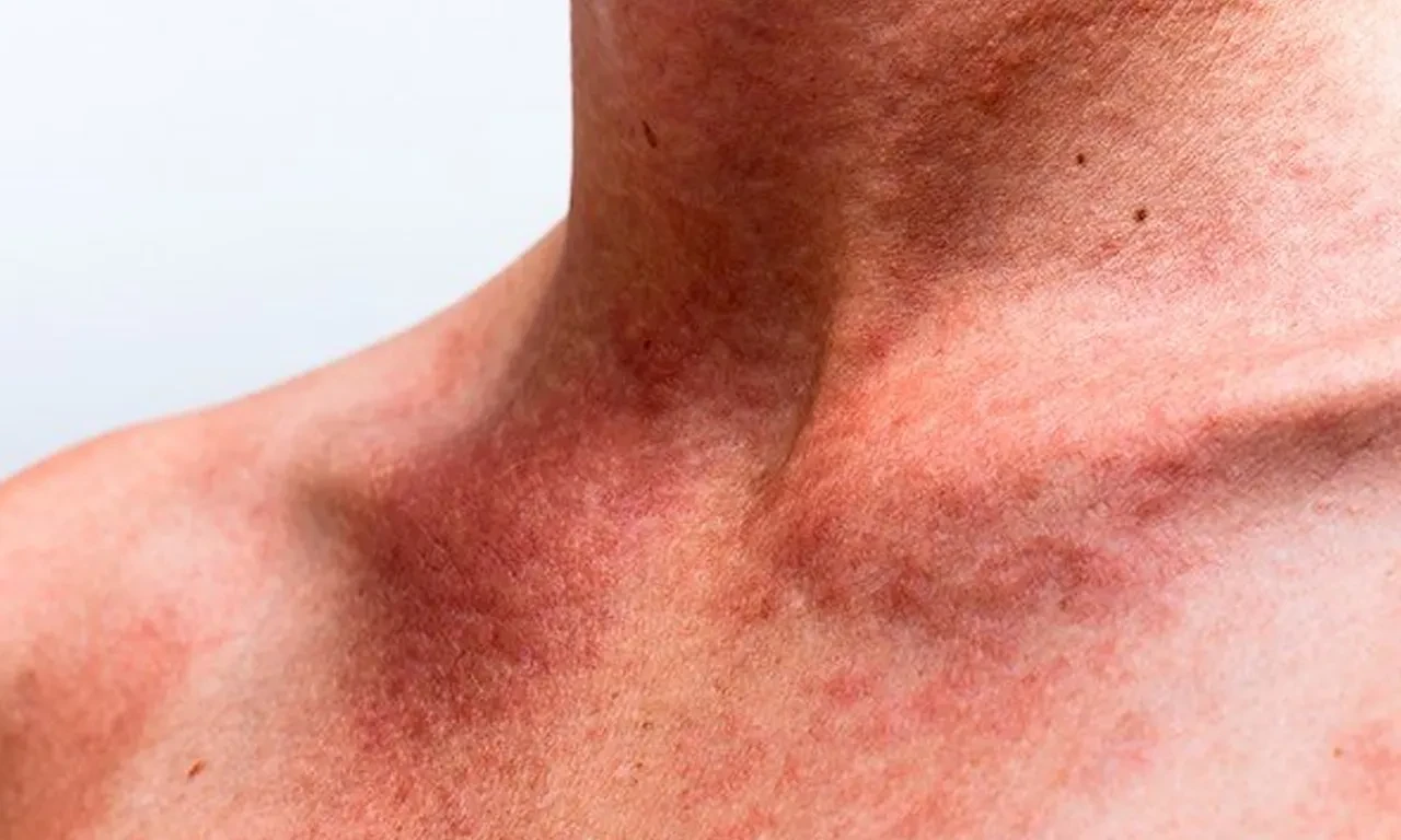 Ciltteki değişimleri hafife almayın! Uzman isimden kritik uyarı