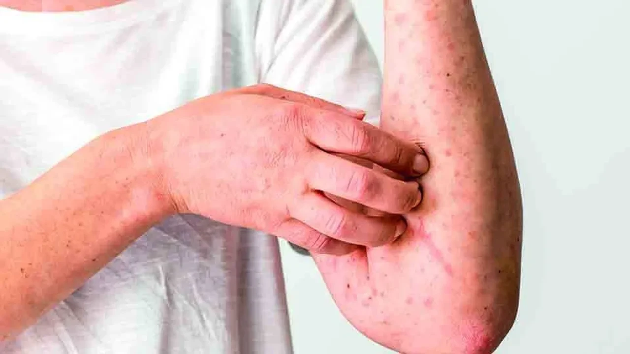 Dünyanın en bulaşıcı hastalığı olarak duyuruldu! 10 kişiden 9’una bulaşıyor