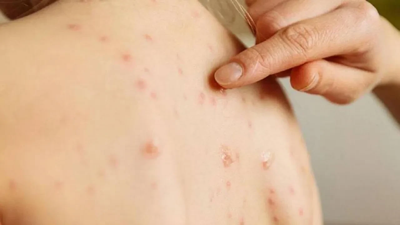 Dünyanın en bulaşıcı hastalığı olarak duyuruldu! 10 kişiden 9’una bulaşıyor