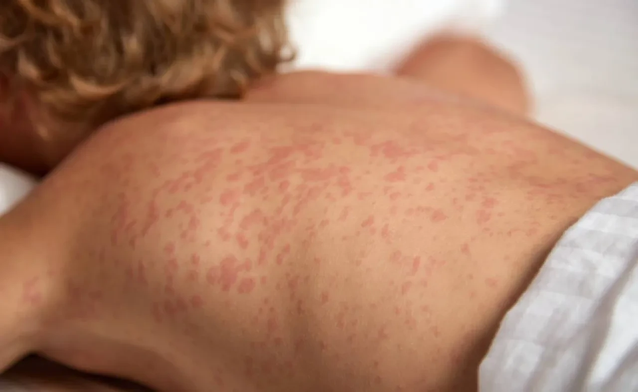 Dünyanın en bulaşıcı hastalığı olarak duyuruldu! 10 kişiden 9’una bulaşıyor