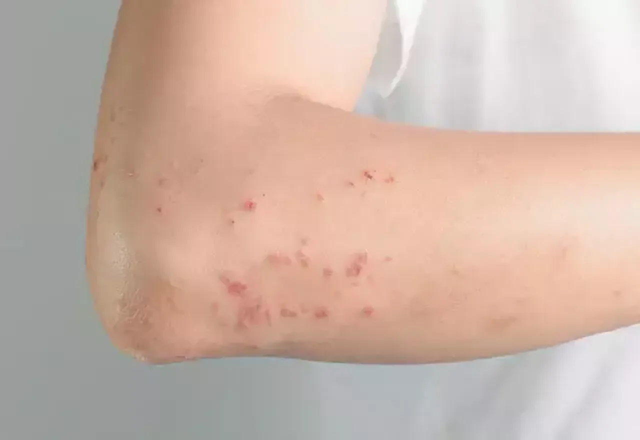 Dünyanın en bulaşıcı hastalığı olarak duyuruldu! 10 kişiden 9’una bulaşıyor