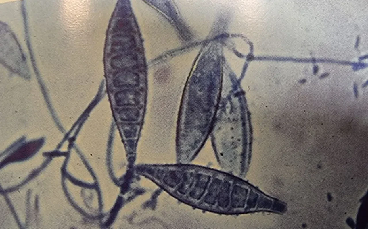 İnsan vücudunu içeriden çürüten mantar hızla yayılıyor