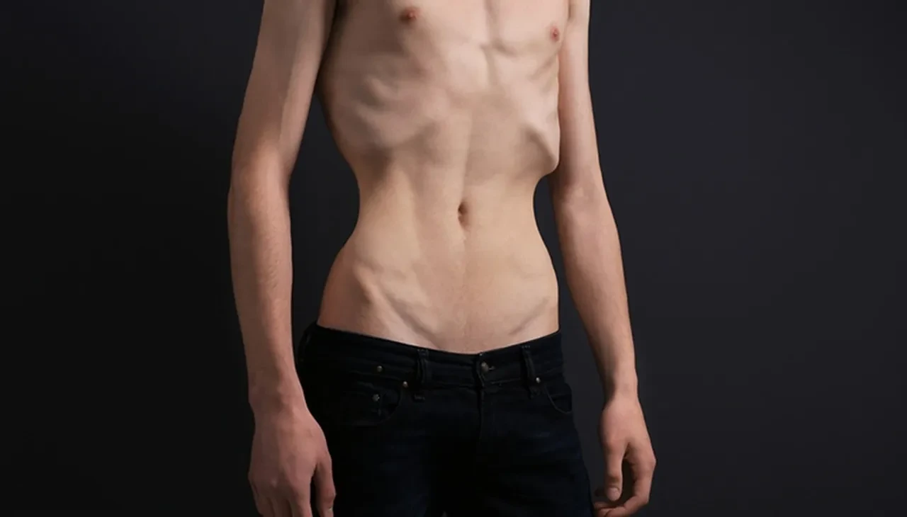 Anoreksiya nedir neden olur? Zayıflamak isterken canınıza kastetmeyin