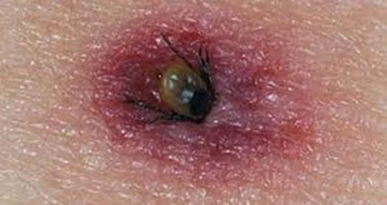 Kene çıkarırken dikkat! Bu hatalar ölümle sonuçlanabilir