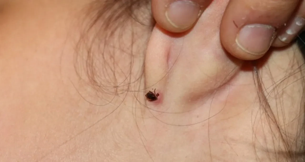 Kene çıkarırken dikkat! Bu hatalar ölümle sonuçlanabilir