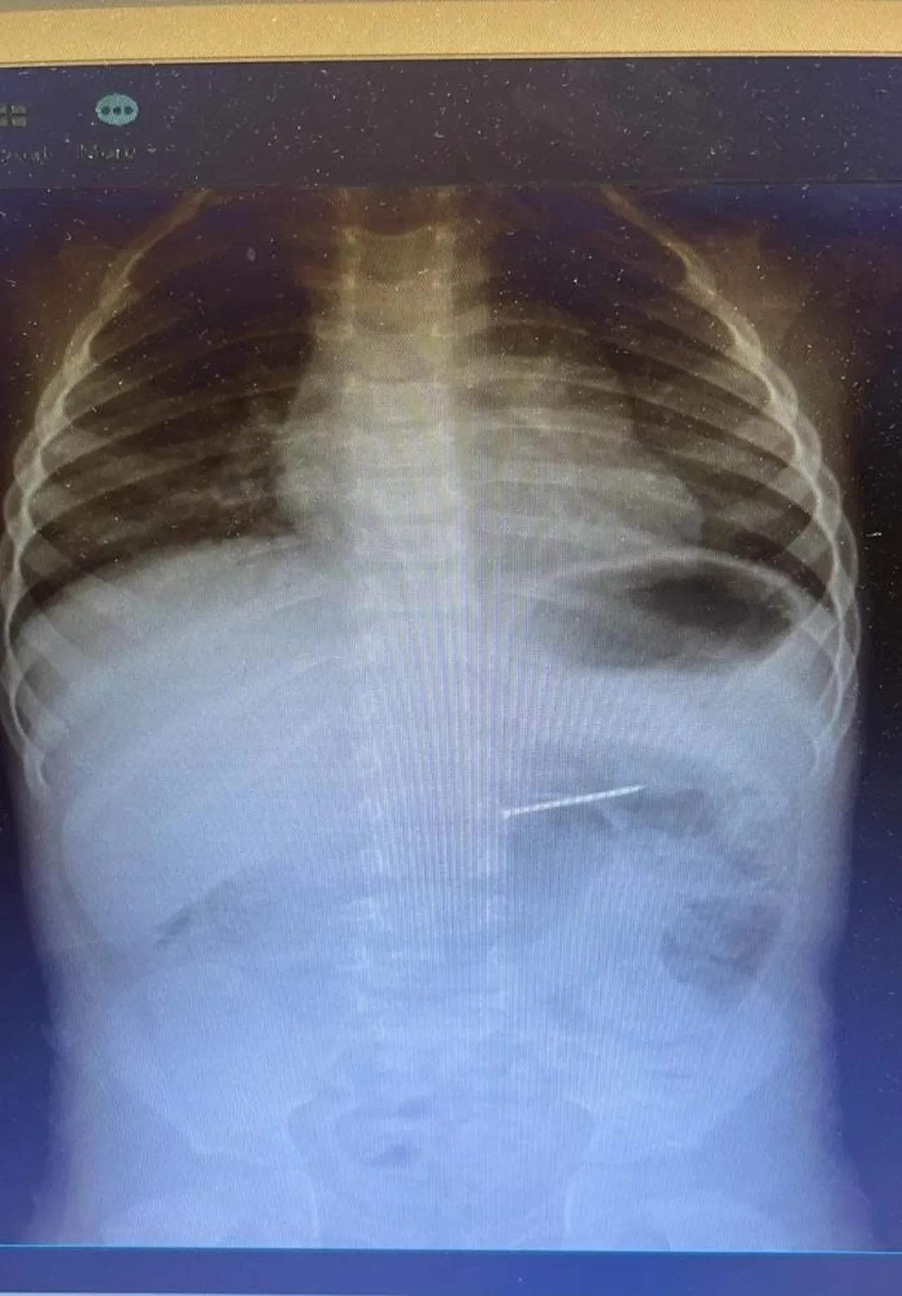 Çocuğun yuttuğu şey ailesine ecel terleri döktürdü! Çıkana herkes şaşırdı