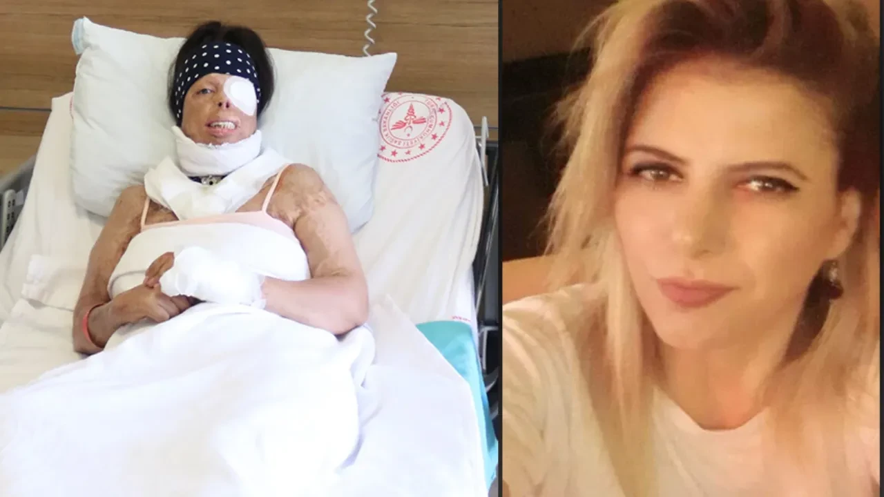 Ayrıldığı sevgilisi hayatını kabusa çevirdi! Uyurken yüzüne ve vücuduna kezzap döktü