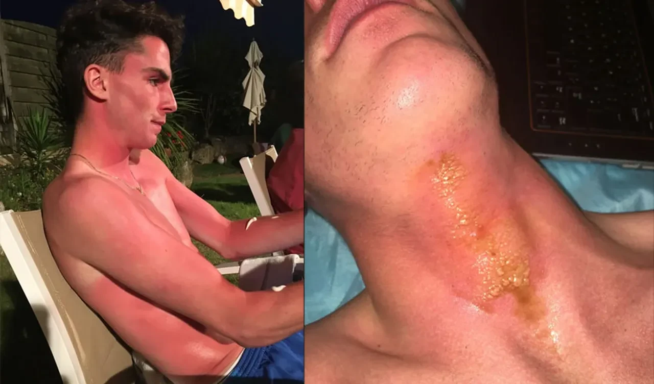 Kolyeyle güneşlenmek hayatının hatası oldu: Derimin gerilip yırtıldığını hissediyordum!