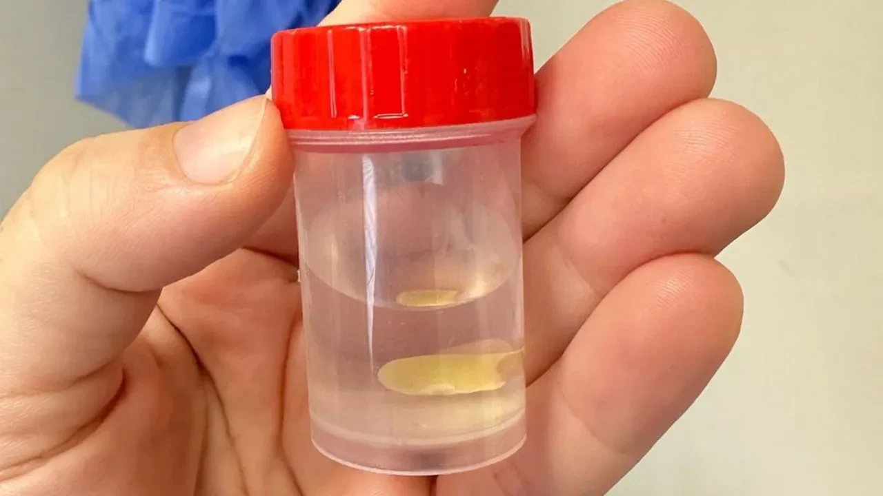 Akıllara durgunluk veren olay: Nefes borusuna kaçtı, aylar sonra ortaya çıktı